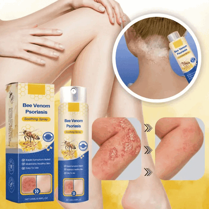 Silvelyo™ Bee Venom Spray 2x1: Alivio inmediato para piel sensible con Psoriasis.