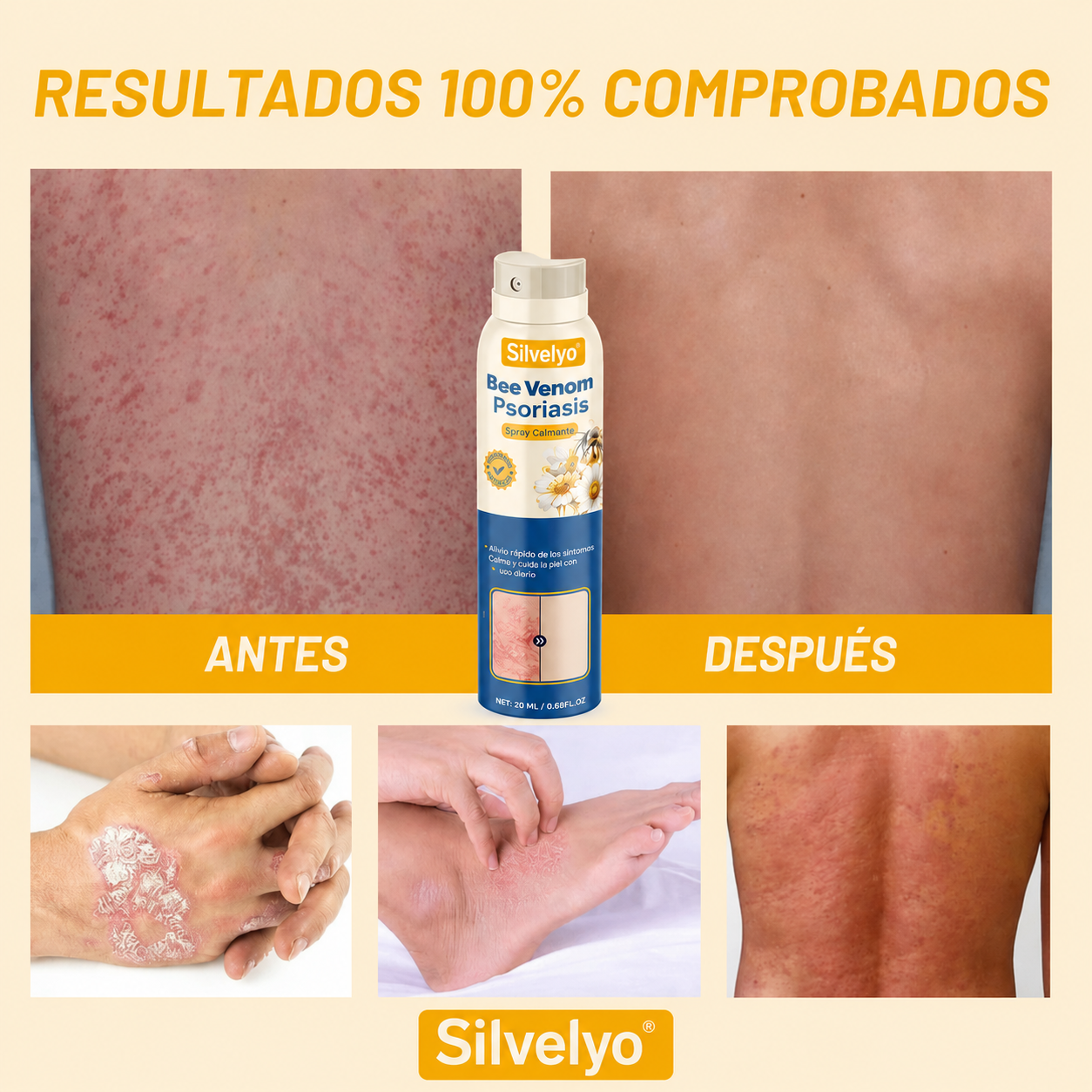 Silvelyo™ Bee Venom Spray 2x1: Alivio inmediato para piel sensible con Psoriasis.