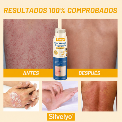 Silvelyo™ Bee Venom Spray 2x1: Alivio inmediato para piel sensible con Psoriasis.