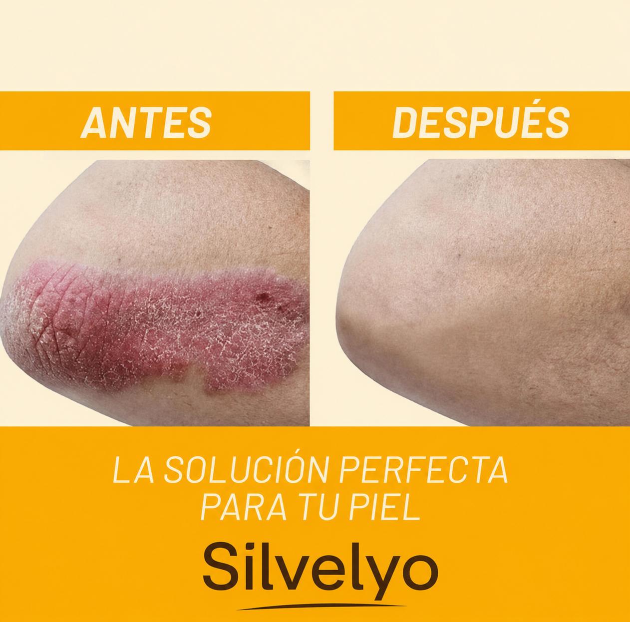 Silvelyo™ Bee Venom Spray 2x1: Alivio inmediato para piel sensible con Psoriasis.