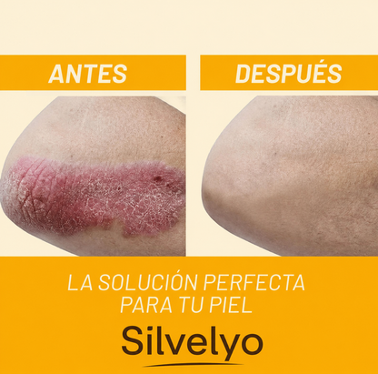 Silvelyo™ Bee Venom Spray 2x1: Alivio inmediato para piel sensible con Psoriasis.