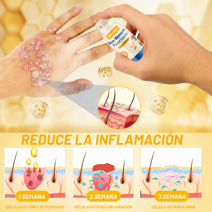 Silvelyo™ Bee Venom Spray 2x1: Alivio inmediato para piel sensible con Psoriasis.