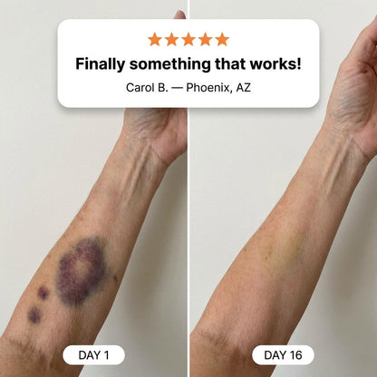 💥100K+ SOLD💕- Silvelyo™ Bruise Repair & Skin-Strengthening Cream